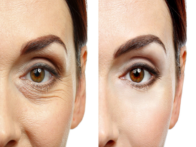 blefaroplastia